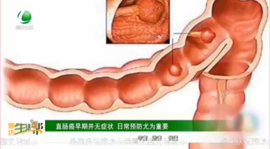 直肠癌早期并无症状 日常预防尤为重要